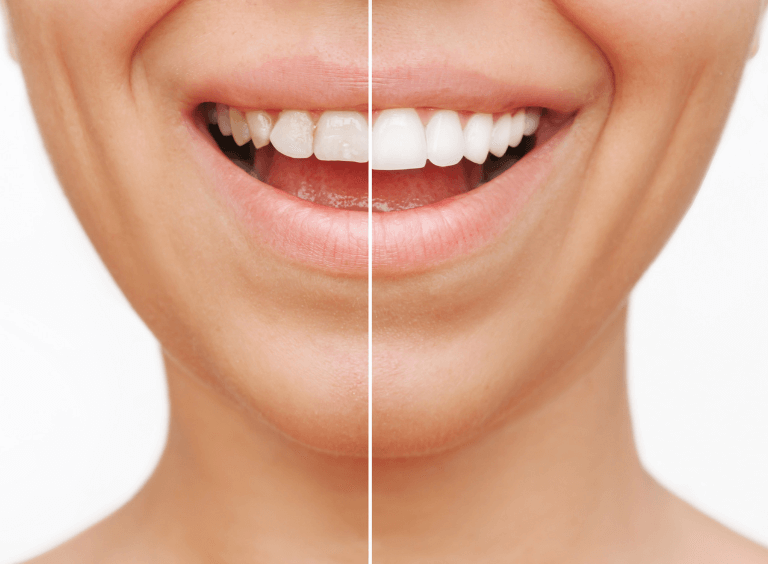 woman before and after teeth whitening at Harwood Dental Practice in Bolton