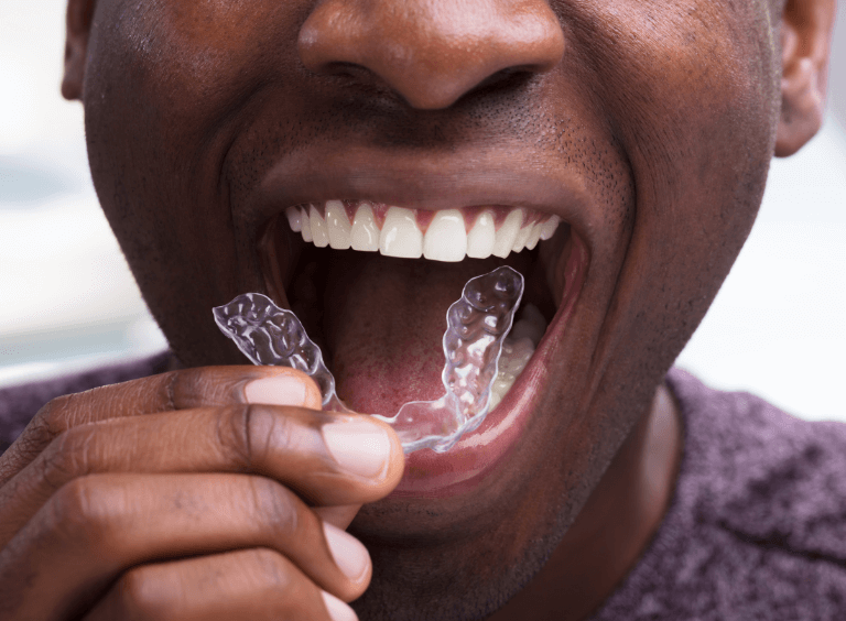 Man putting in Invisalign at Harwood Dental Practice