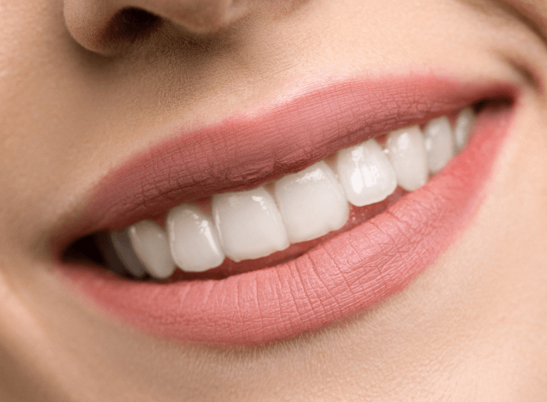 Woman's teeth after teeth whitening at Harwood Dental Practice