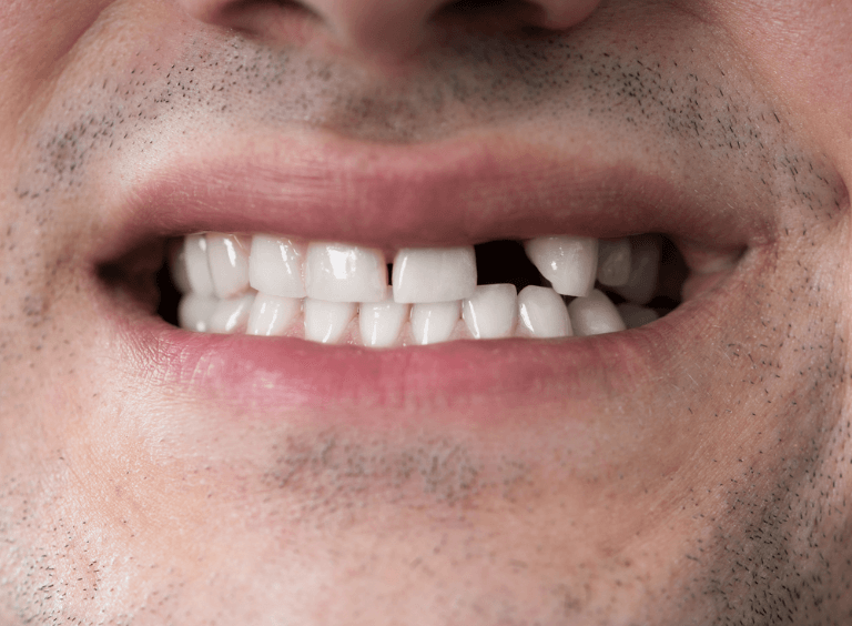 Man before dental implants at Harwood dental practice