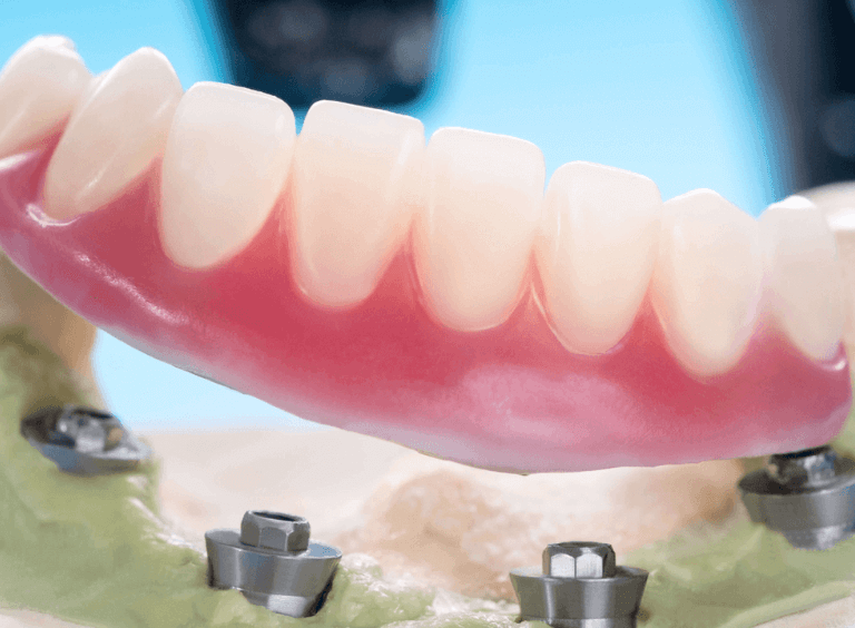 dental implants model at Harwood Dental care practice in Bolton