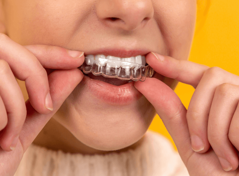 Girl putting Invisalign clear braces from Harwood Dental Care into mouth